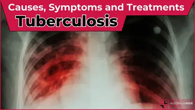 Tuberculosis article header